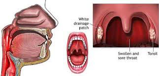 Symptoms of Sore Throat