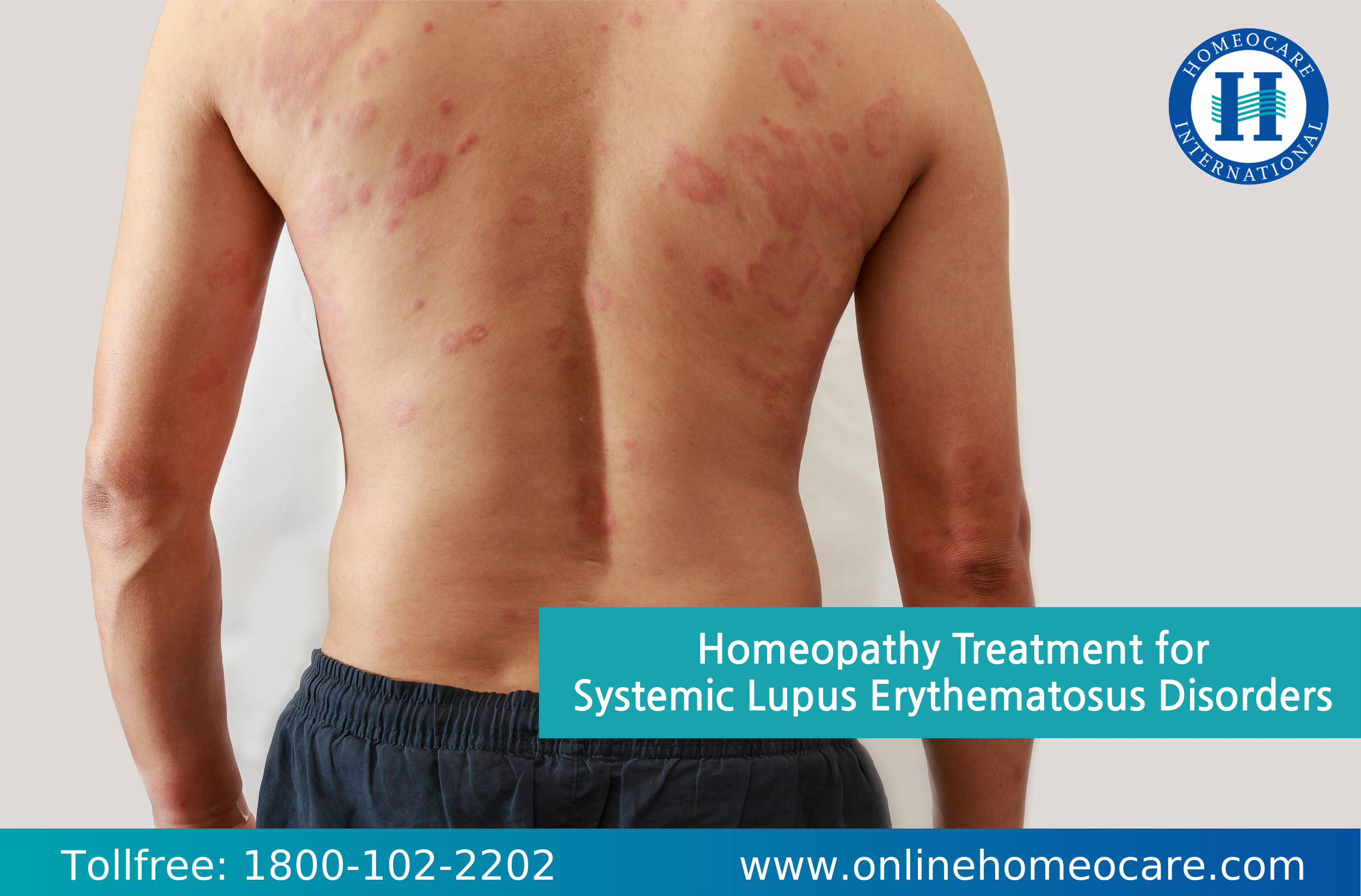 Homeopathy Treatment for Systemic Lupus Erythematosus Disorders